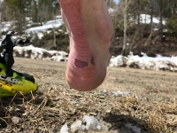 Chad's Blisters