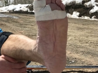 Eric's trench foot