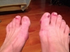Emily B\'s feet after the heat and swelling